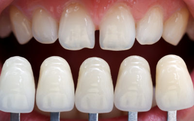 Dental Veneers