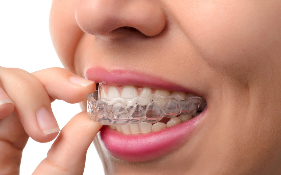 Improve Your Smile with Invisalign Braces