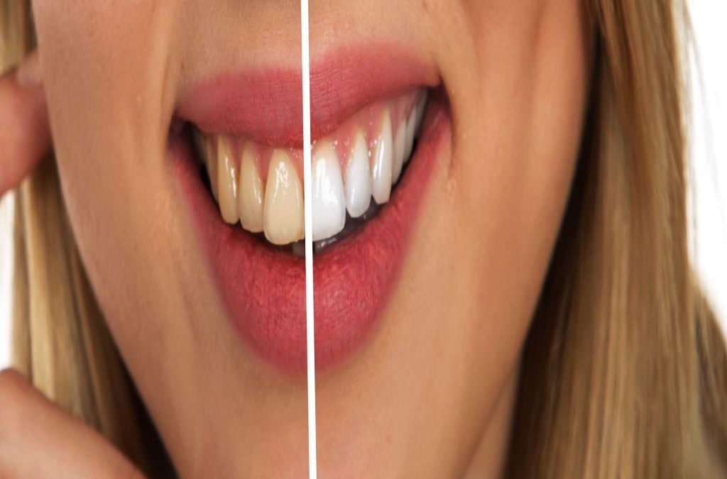 4 foods to avoid after youve gotten your teeth whitened