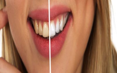 4 Foods to Avoid after You’ve Gotten Your Teeth Whitened