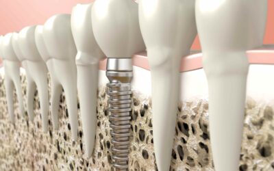 Pros and Cons of All-On-4 Dental Implants