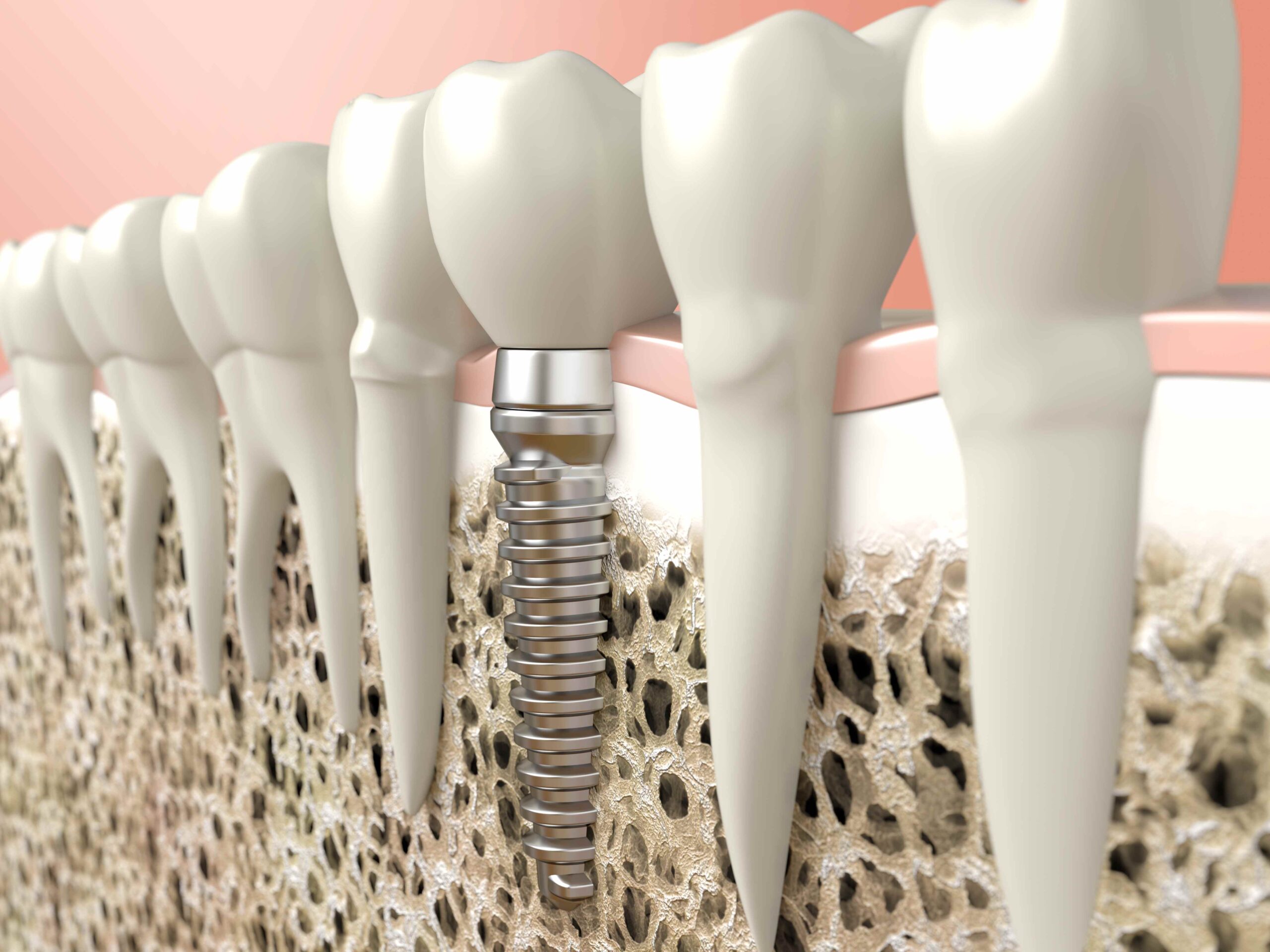 Advantages and disadvantages of AllOn4 Dental Implants