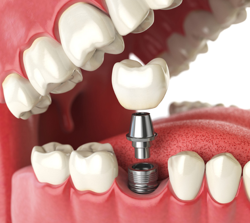 all-on-4 dental implants near you<br />
